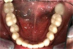 dental crowns after