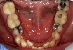 dental crowns before